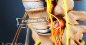 Herniated Disc 1